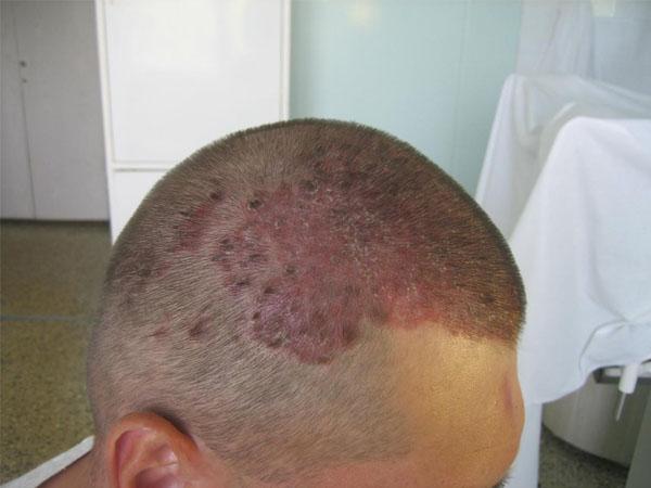 Лосьон и спрей от псориаза на голове: лучшие средства от проблемы волосистой части головы, инструкция по применению, состав, цена