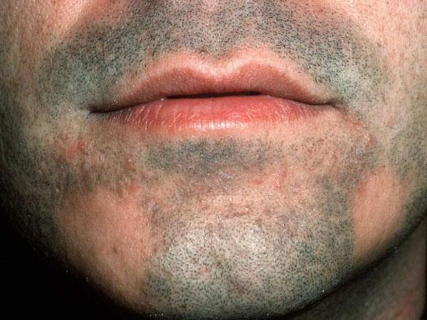 Алопеция на бороде у мужчин: как лечить выпадение волос, облысение и проплешины на подбородке, причины, профилактика