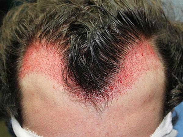 Пересадка волос на голове: цена, отзывы пациентов, операция и безоперационная методика, фото до и после у женщин и мужчин, какие могут быть результаты, реабилитация