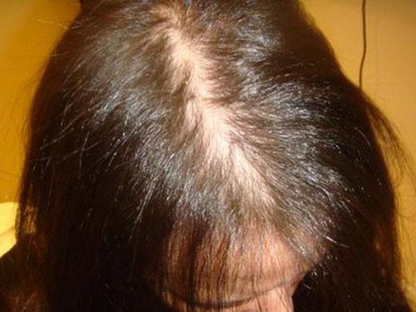 Себорейная алопеция: выпадение волос при дерматите у женщин и мужчин, лечение, фото, причины облысения