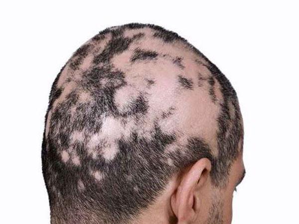 Сухая кожа головы и выпадение волос могут быть симптомами алопеции при сифилисе, как лечить сифилитическое облысение
