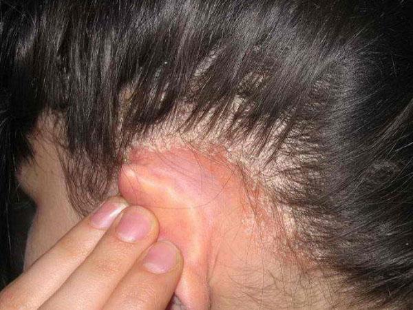 Дерматоз: симптомы и лечение, фото атопического дерматита волосистой части головы, течение болезни у взрослого и ребенка