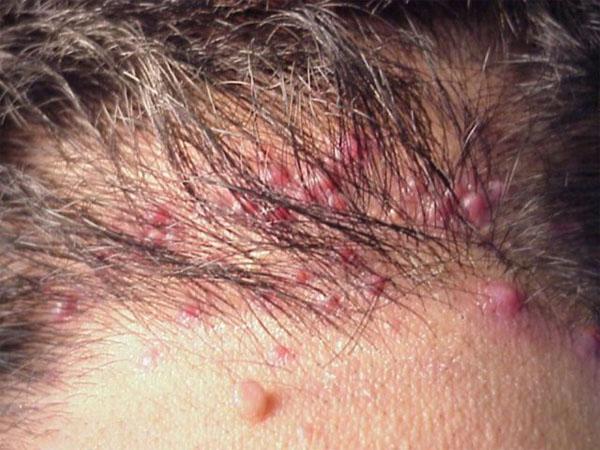 Прыщи на голове в волосах: у мужчин и женщин, лечение гнойников на коже затылка и не только, причины почему появляются прыщики, которые чешутся у взрослого, фото