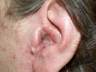 Себорейный дерматит в ушах: лечение мазью, фото, профилактика себореи ушных раковин, аптечные лекарства и народные средства